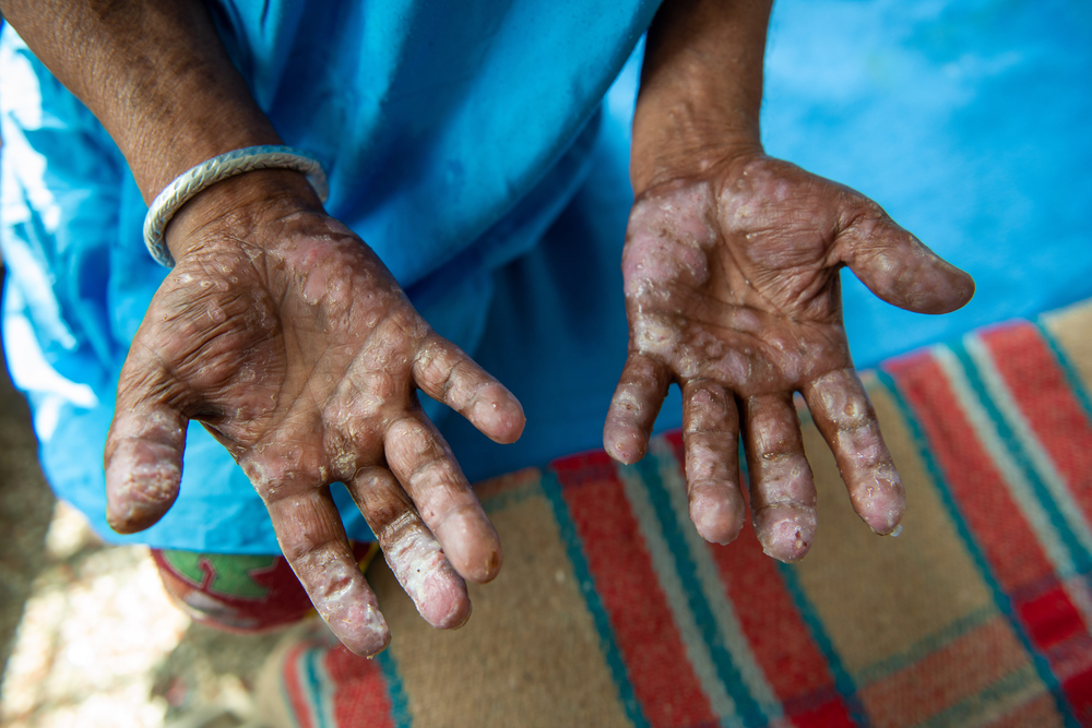 imagen del articulo Latinoamérica: piden mayores esfuerzos en el control de la lepra